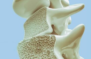 Ostéoporose ou décalcification osseuse